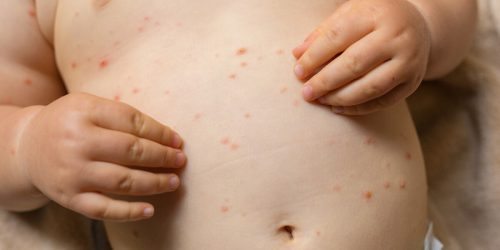 Lékařka radí - plané neštovice u dětí